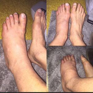 Imagens divulgadas por Caio, mostrando a situação dos pés do lutador após a lesão. Foto: Arquivo Pessoal