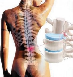hernia-de-disco-cor-236x250